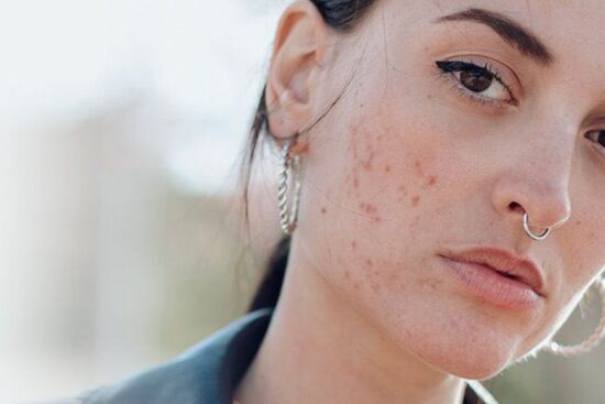 Bí quyết trị sạch mụn đầy mặt hiệu quả tại nhà