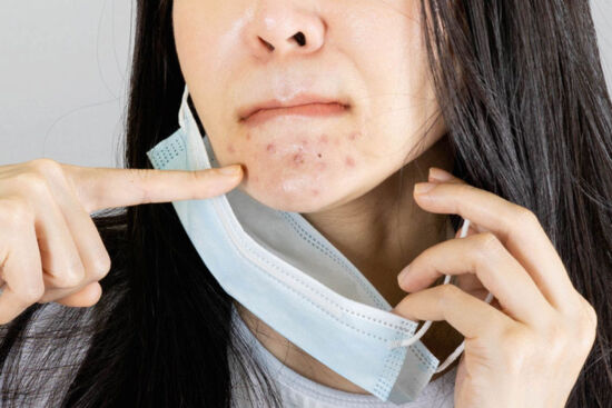 Maskne: nổi mụn do đeo khẩu trang và cách khắc phục