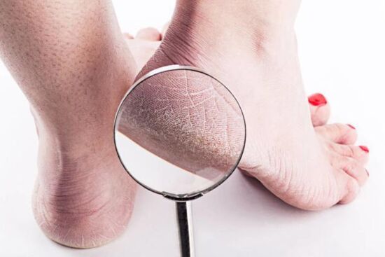 Cách làm lành bàn chân cực kỳ khô bị nứt gót
