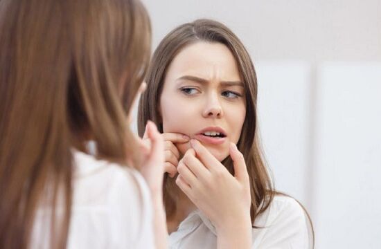 Có nên nặn mụn hay không?