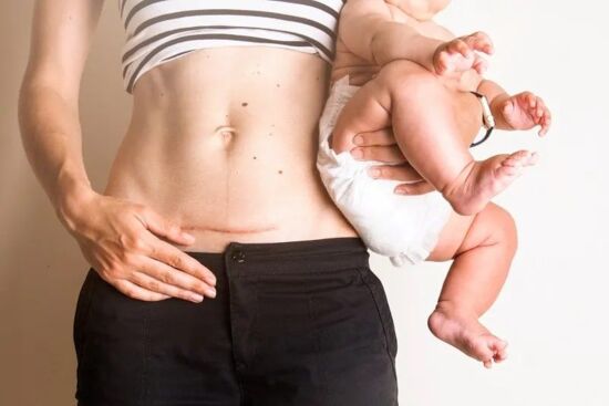 Cách trị sẹo sau sinh mổ